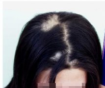 什么原因會(huì)造成斑禿